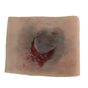 Elderly Skin Tear